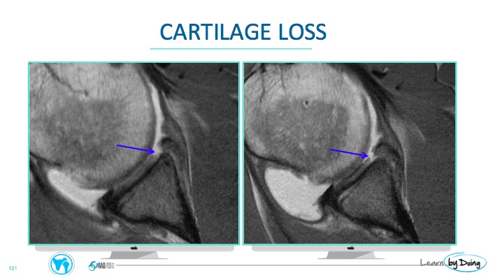 Shoulder Labrum MRI: Glenoid Cartilage | Radedasia