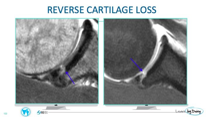 Shoulder Labrum Mri Glenoid Cartilage Radedasia