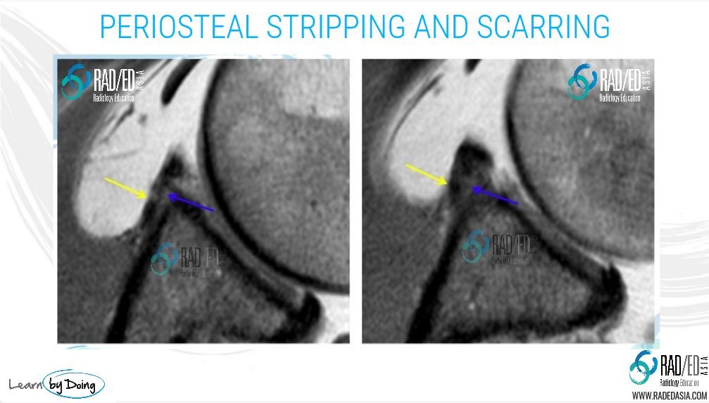 shoulder-mri-periosteum-stripping-scarring-radedasia-radiology-education