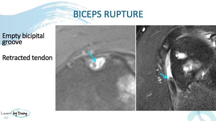 Distal Biceps Tendon Tear MRI