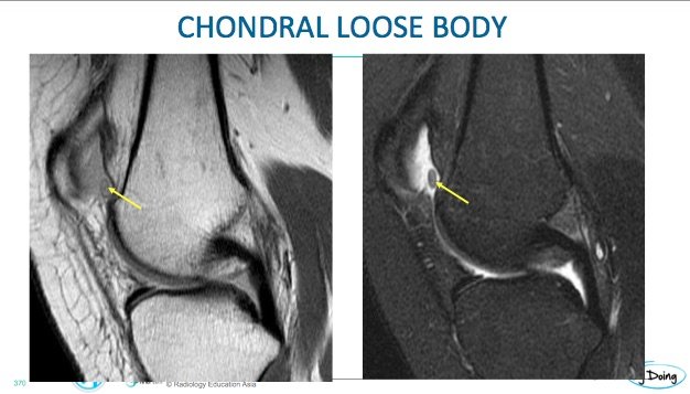 MRI Cartilage - Radedasia