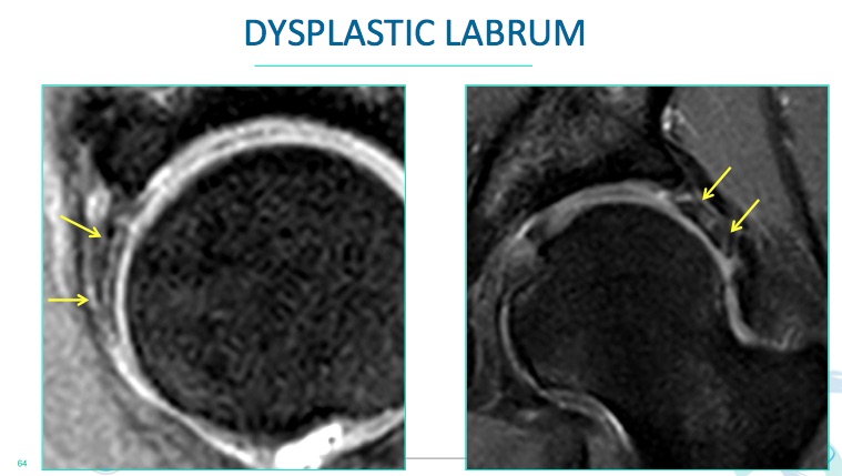 Hip Labrum Mri Anatomy