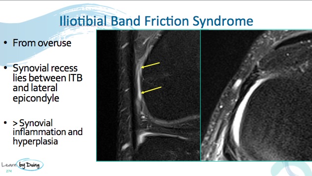 MRI Iliotibial Band Friction - Radedasia