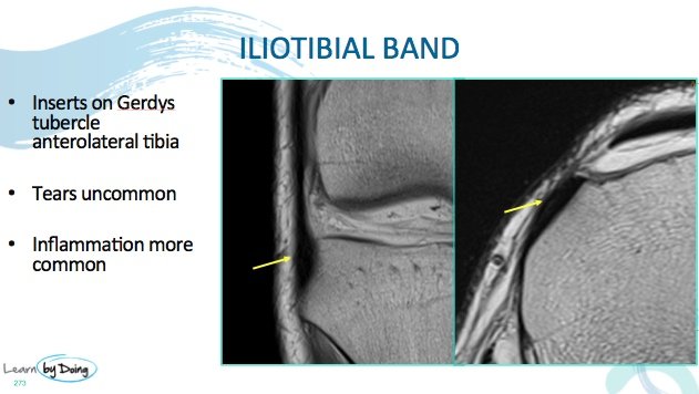 iliotibial band syndrome mri hogyan kezeljük a térdrándulás kezelését