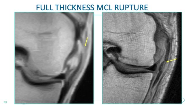 Knee MRI MCL Tear – Radiology Education Asia