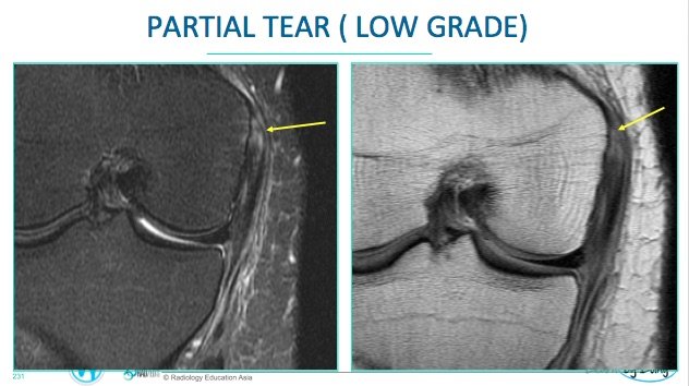 Knee MRI MCL Tear – Radiology Education Asia