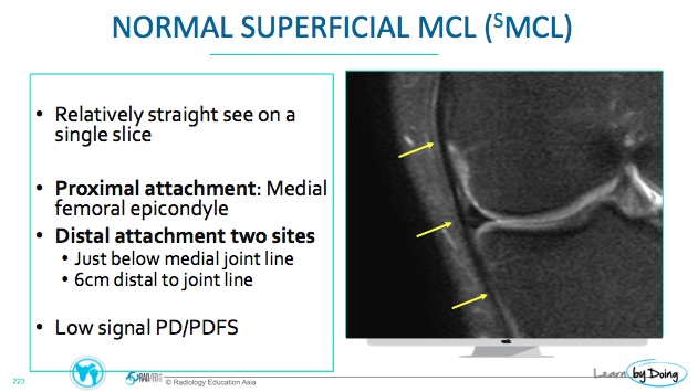 MCL: Deep and Superficial Ligaments – Radiology Education Asia