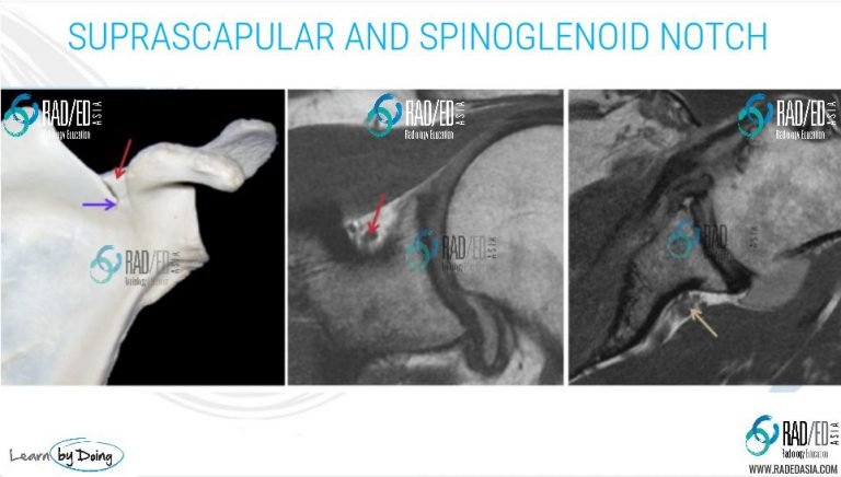 mri-shoulder-denervation-parsonage-turner-syndrome-infraspinatus-supraspinatus-paralabral-cyst-spinoglenoid-suprascapular-notch-radiology-education-asia-radedasia