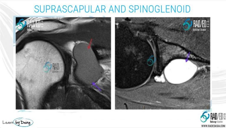 mri-shoulder-denervation-parsonage-turner-syndrome-infraspinatus-supraspinatus-paralabral-cyst-spinoglenoid-suprascapular-radiology-education-asia-radedasia