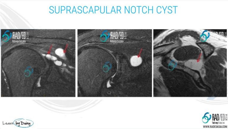 mri-shoulder-denervation-parsonage-turner-syndrome-infraspinatus-supraspinatus-paralabral-cyst-suprascapular-notch-radiology-education-asia-radedasia