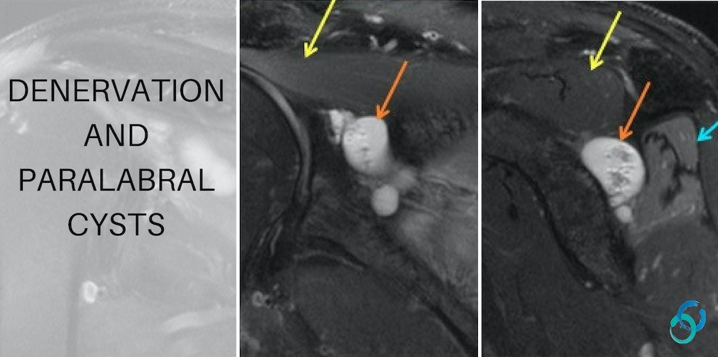mri shoulder denervation parsonage turner syndrome supraspinatus infraspinatus paralabral cyst suprascapular spinoglenoid notch anatomy radiology education asia