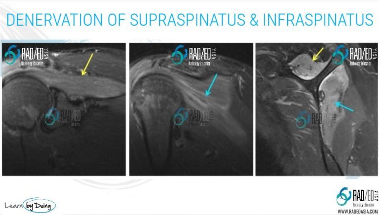 mri-shoulder-denervation-parsonage-turner-syndrome-supraspinatus-infraspinatus-paralabral-cyst-suprascapular-spinoglenoid-notch-radiology-education-asia-radedasia