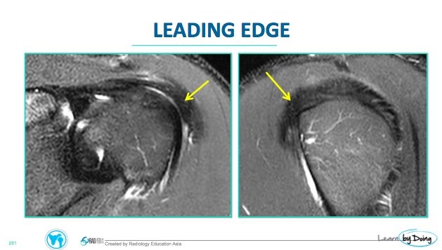 MRI Shoulder Rotator Cuff Footprint Tears - Radedasia