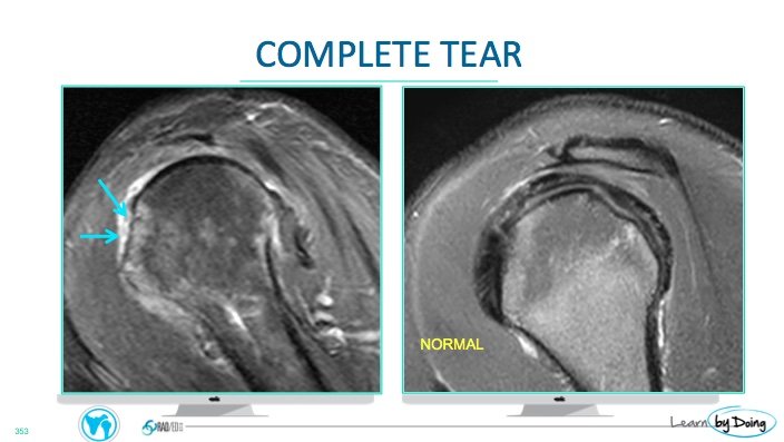 MRI Subscapularis Tears - Radedasia