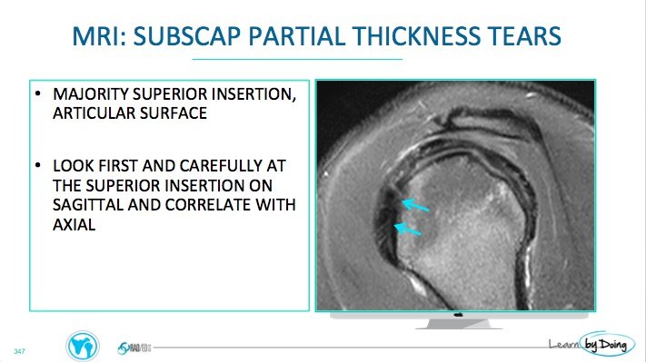 MRI Subscapularis Tears - Radedasia