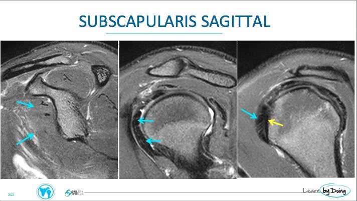 MRI Subscapularis Tears - Radedasia