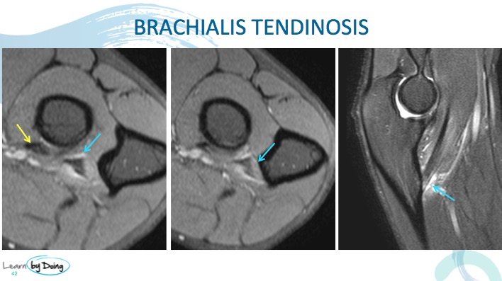 MRI of the Brachialis Tendon Insertion | Radedasia