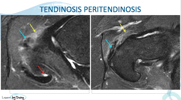 Hip MRI Gluteal Tendon Abnormalities - Radedasia