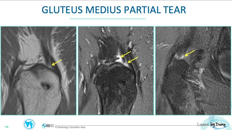 Gluteus Medius Tendon Tear