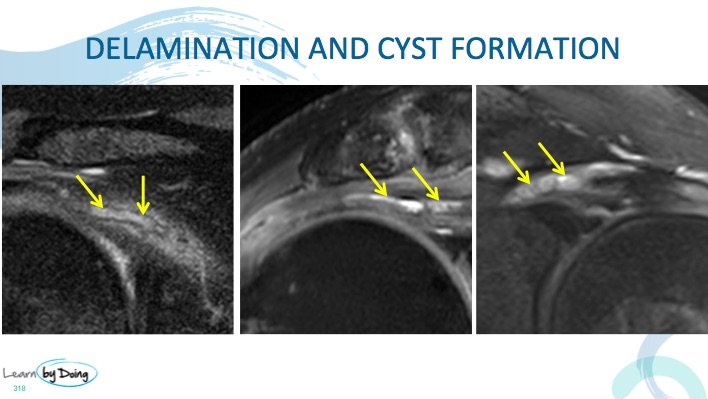 Shoulder MRI : Delamination of Rotator Cuff Tendons - Radedasia