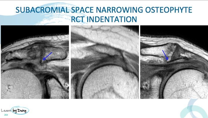 MRI Shoulder Sub Acromial Impingement - Radedasia