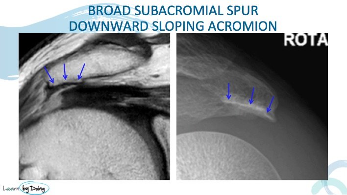 MRI Shoulder Impingement Syndrome