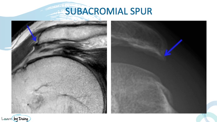 MRI Shoulder Sub Acromial Impingement | Radedasia