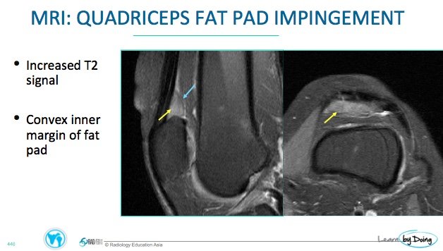 mri knee fat pad impingement quadriceps impingement radiology education asia
