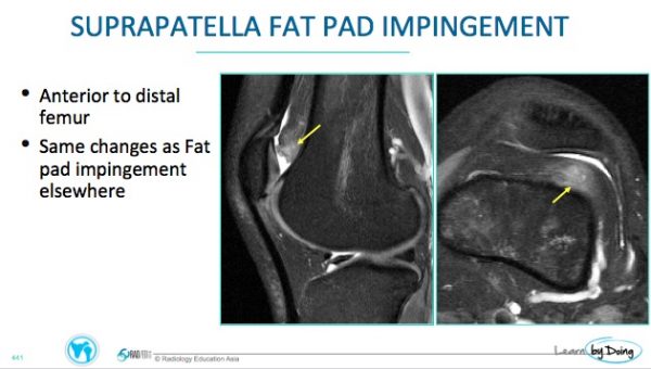 MRI KNEE: FAT PAD IMPINGEMENT - Radedasia