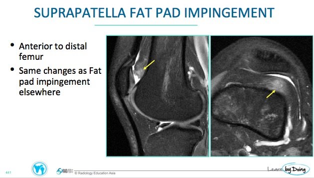 KNEE MRI FAT PAD IMPINGEMENT WHERE TO LOOK WHAT TO LOOK FOR Radedasia