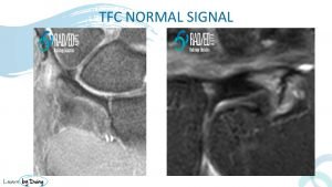 TFC normal signal wrist radedasia radiology education asia