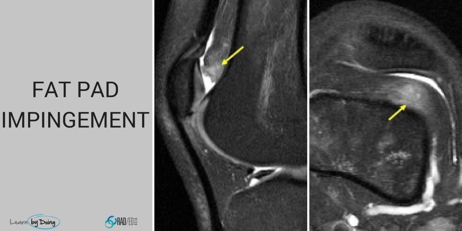 MRI KNEE: FAT PAD IMPINGEMENT - Radedasia