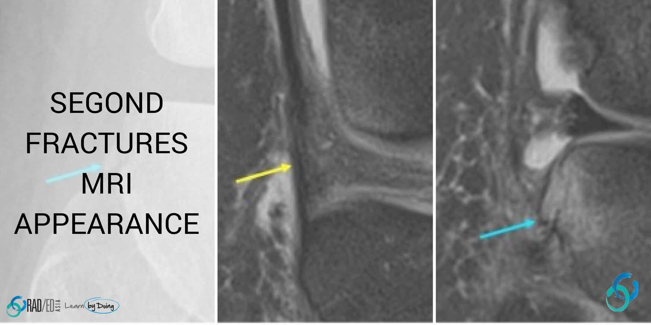 mri knee segond fracture radiology education asia