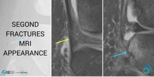 mri knee segond fracture radiology education asia