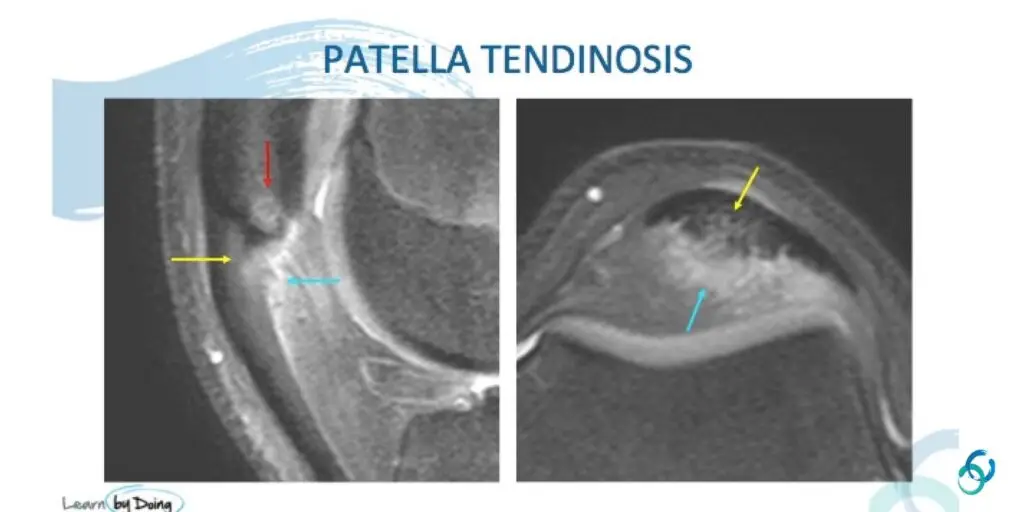 mri patella tendinosis tear radiology education asia