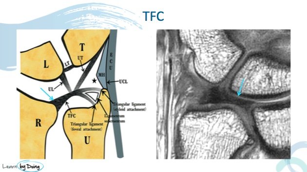 Tfcc Wrist Mri