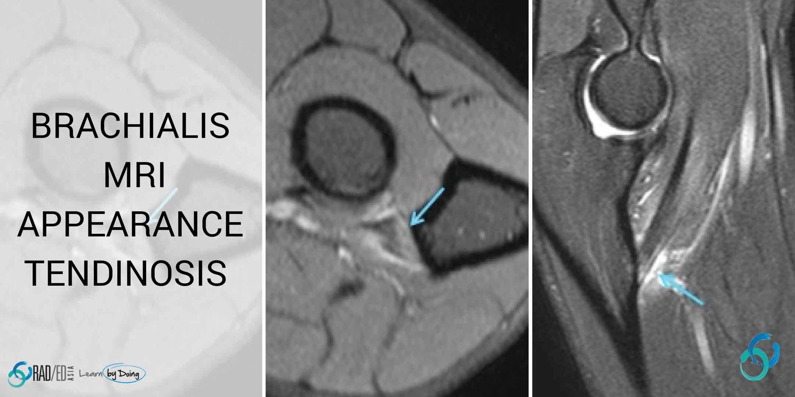 elbow mri brachialis tendon tears tendinosis radiology education asia
