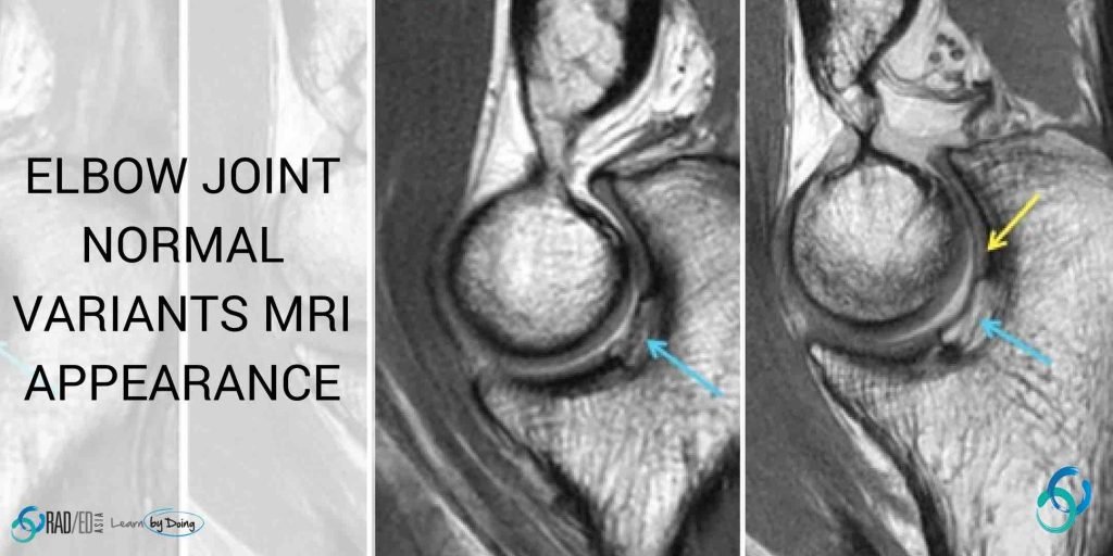 elbow mri normal variant radiology education asia