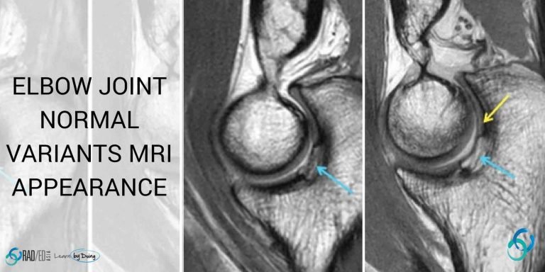Elbow Joints Normal Variants on MRI - Radedasia