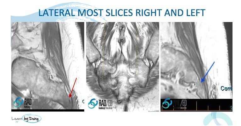 mri sacral ala fracture raded asia radiology education