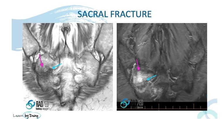 HOW TO FIND A SACRAL FRACTURE ON A LUMBAR MRI - Radedasia