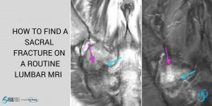 sacral fracture lumbar mri radiology education asia