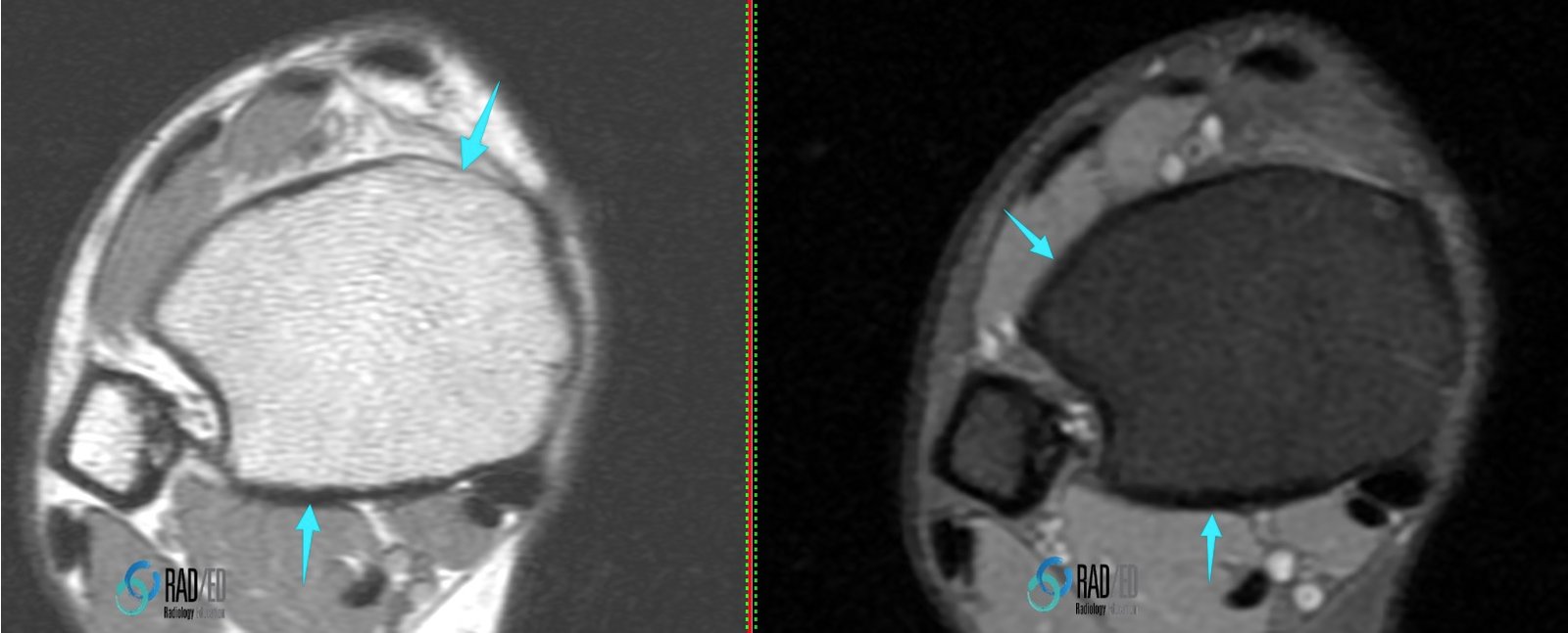 cortex-and-periosteum-normal-radiology-education-asia-radedasia