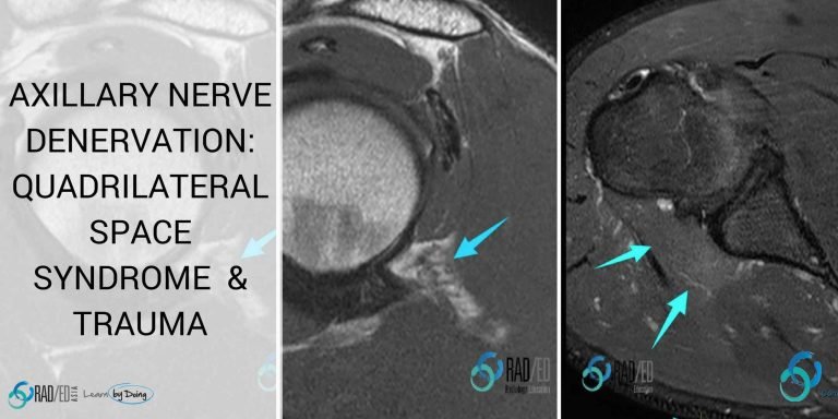 MRI SHOULDER DENERVATION: Quadrilateral Space Syndrome and Dislocation ...