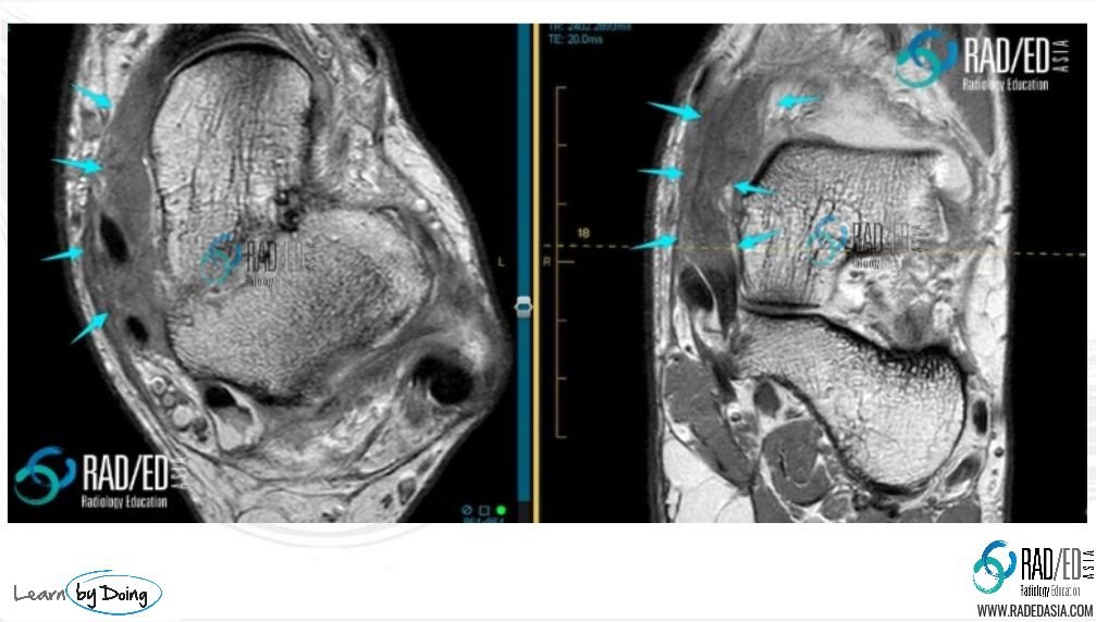 deltoid-scar-hypertrophic-mri-radiology-education-asia-radedasia