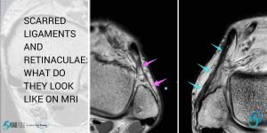 ligament retinacula scar mri radiology education asia radedasia