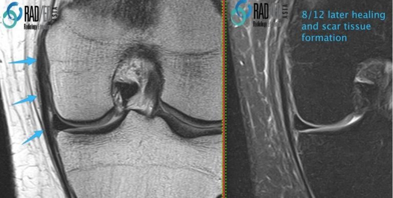 Scarred Ligaments and Retinacula: What does Scar tissue look like on ...