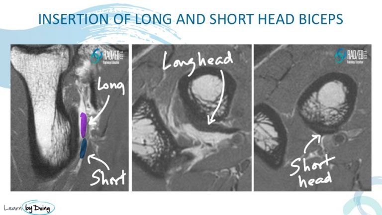 Distal Biceps Tendon Double Trouble Radedasia