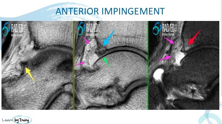 anterior impingement ankle mri radiology education asia