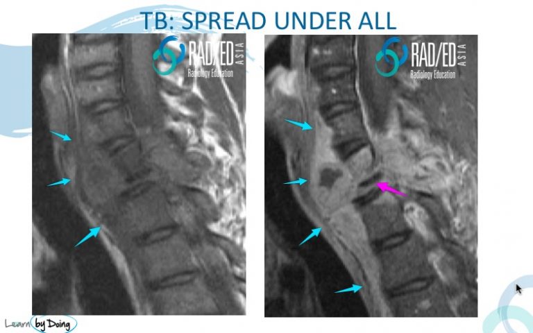 Is It Tb? : What Does Spinal Tb Look Like On Mri - Radedasia